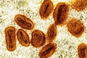 US Health officials report first known case of new, more severe strain of monkeypox