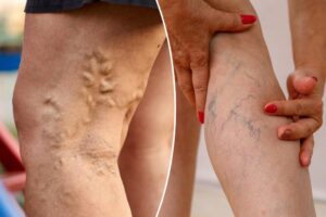 The difference between varicose veins and spider veins — and how you can actually prevent them