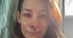 Evangeline Lilly Shares Photos of Facial Injuries After Fainting, Falling Face-First Into Boulder