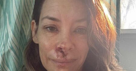 Evangeline Lilly Shares Photos of Facial Injuries After Fainting, Falling Face-First Into Boulder