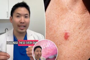 I’m a dermatologist — these easily overlooked signs on your skin may indicate cancer