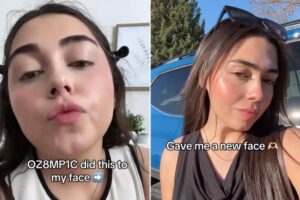 ‘Ozempic face’ might cause sagging skin — but one user loves her new look: ‘Like I got jawline filler’