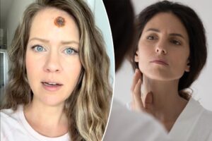 Single mom, 33, shares PSA about ‘small’ sign that turned out to be ‘gruesome’ cancer: ‘People should get the shock value’