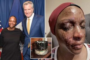Bath & Body Works candle explodes in former NYC official’s face, unleashing ‘unrelenting’ pain: lawsuit