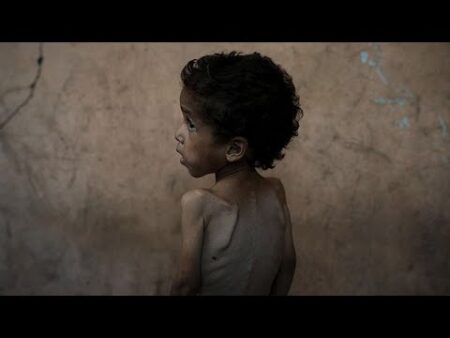 Gaza’s children are starving. What does malnutrition do to the human body?