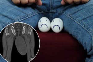 Tumor the size of a chicken egg found in man’s scrotum — due to rare condition usually found in vaginas