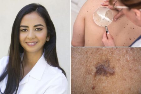The ‘ABCDEs’ of skin cancer — 9 clues you shouldn’t ignore