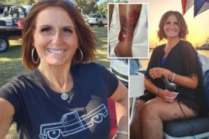Mom nearly loses life and leg after contracting flesh-eating bacteria during Florida swim: ‘The pain is unbelievable’