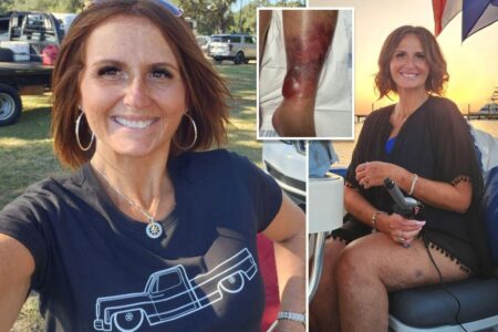 Mom nearly loses life and leg after contracting flesh-eating bacteria during Florida swim: ‘The pain is unbelievable’