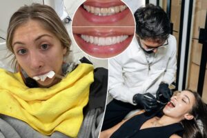 Exclusive | Celebs made veneers a popular post-pandemic cosmetic quick fix — but regret is on the rise: ‘My mouth is permanently screwed up’