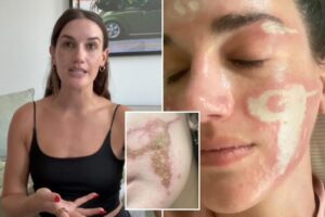 My session with a celebrity aesthetician left me burned, scarred and irreparably damaged