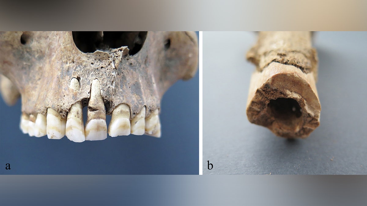 Close-up of skeleton teeth, injuries