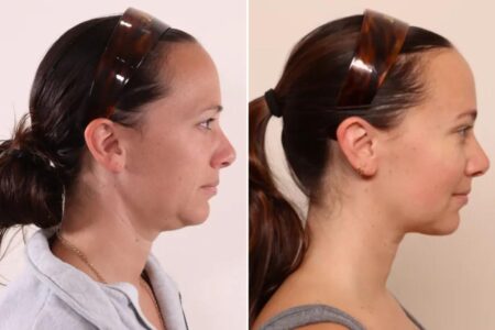 Exclusive | ‘Shrink wrapping’ is the hot new skin-tightening and fat-melting treatment people are getting for ‘Ozempic face’