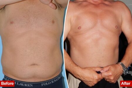Exclusive | The rise of ‘masculine contouring’: Meet the men ‘optimizing’ their bodies with liposuction