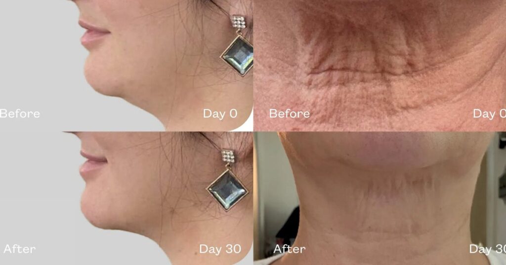 Sagging Jowls? This ‘Magic’ Serum Sculpts the Jaw and Lifts the Neck in Days