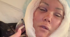 Jelly Roll’s Wife Bunnie Xo Reveals Gruesome Aftermath After Getting Facelift at 46
