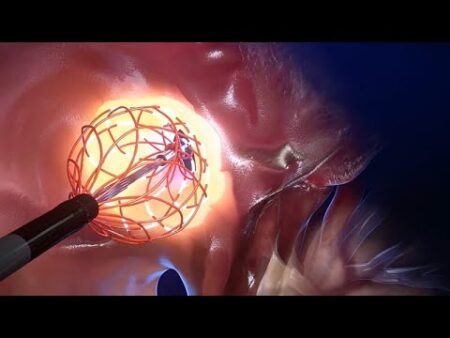 Deep inside the heart: the innovative catheter designed to revolutionise the treatment of arrhythmia