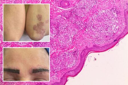 How a popular makeup trend triggered one woman’s full-body disease