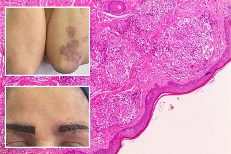 How a popular makeup trend triggered one woman’s full-body disease How a popular makeup trend triggered one woman’s full-body disease