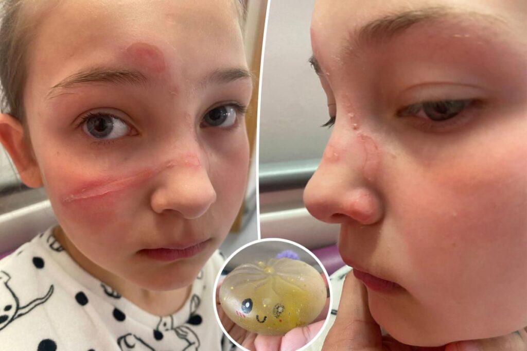 Authorities warn parents about dangerous TikTok challenge with popular children’s toy that causes ‘traumatizing’ burns