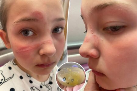 Authorities warn parents about dangerous TikTok challenge with popular children’s toy that causes ‘traumatizing’ burns