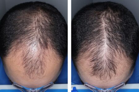 Experimental hair loss pill just cleared a major hurdle — when it could hit shelves