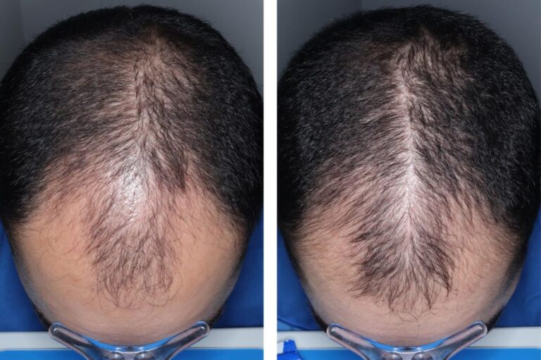 Experimental hair loss pill just cleared a major hurdle — when it could hit shelves