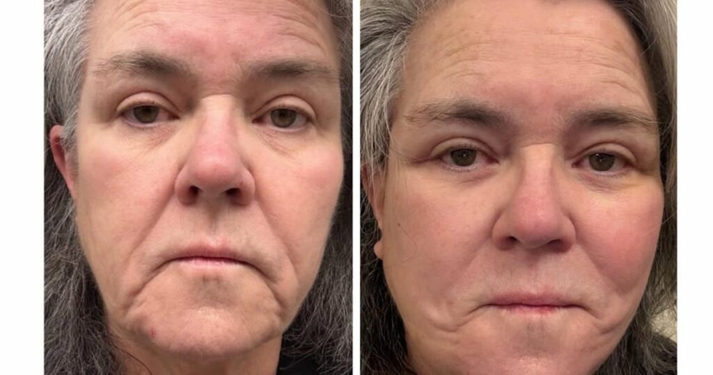 Rosie O’Donnell Shares Before-And-After Photos of Facelift 1 Day After Revealing Cosmetic Procedure