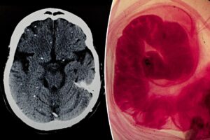 Doctors thought man had deadly brain cancer — the reality was much grosser