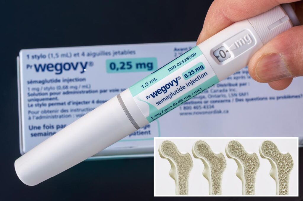 Ozempic and Wegovy may strengthen bones in Type 2 diabetes patients, study finds