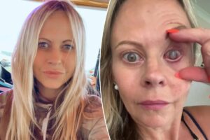 My eye had to be sewn shut after a parasite ate my cornea — the crucial mistake I made My eye had to be sewn shut after a parasite ate my cornea — the crucial mistake I made