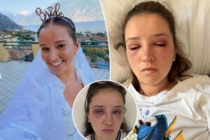 Bride-to-be sounds alarm after popular beauty treatment left her disfigured before the big day