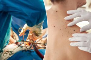 Heart surgery cured a man’s skin cancer — but left him with a bizarre new condition