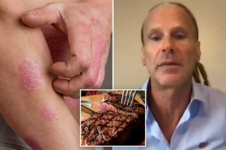 Florida man says meat-only ‘lion diet’ cleared psoriasis, ended decades of depression